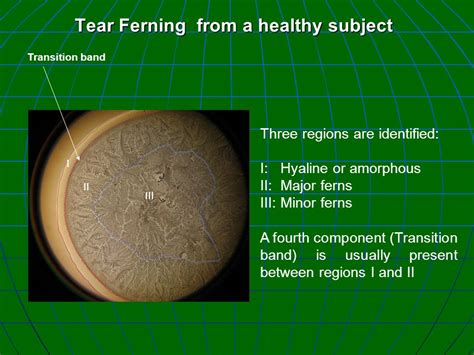 tear ferning test evaluation dry eye|dry eye examination techniques.